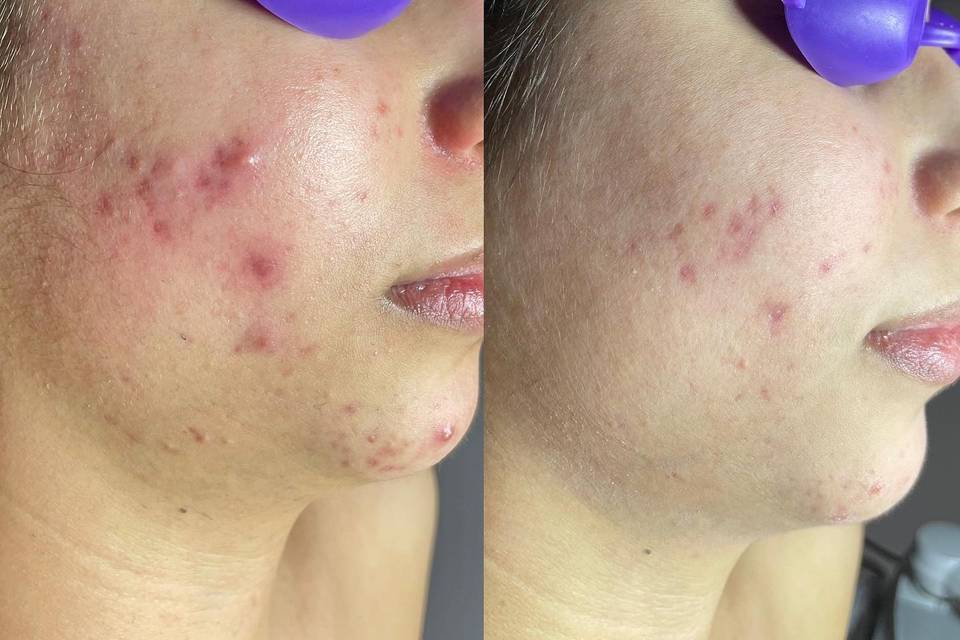 Acne progress