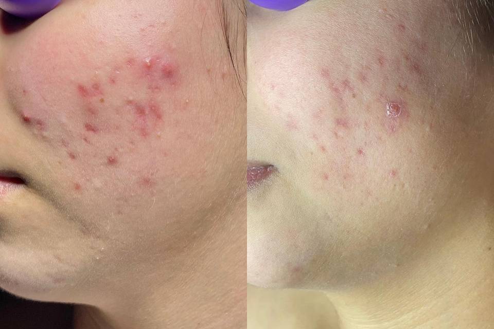 Acne progress