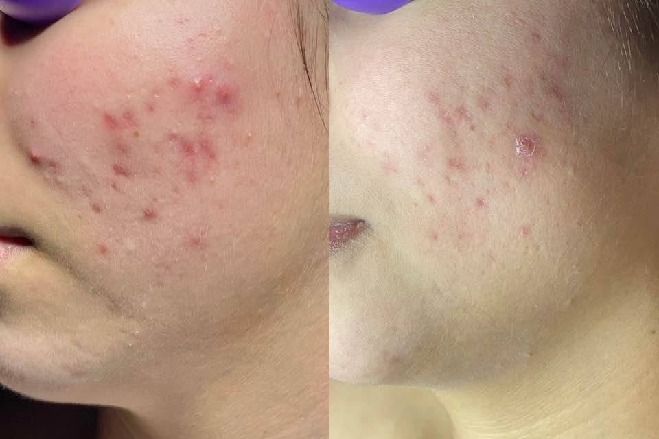 Acne Progress