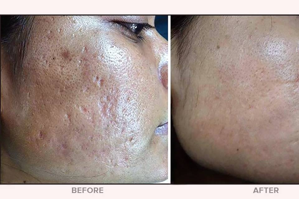Microneedling - Acne Scarring