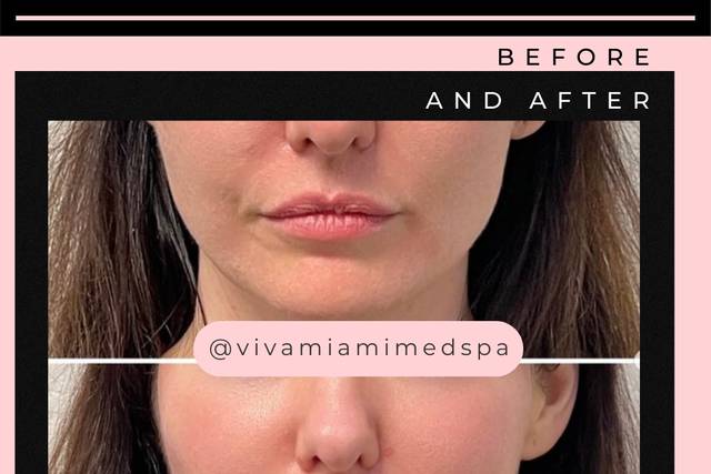 Before & After Lip Fillers