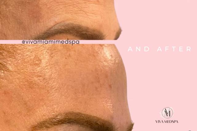 Before and After Botox