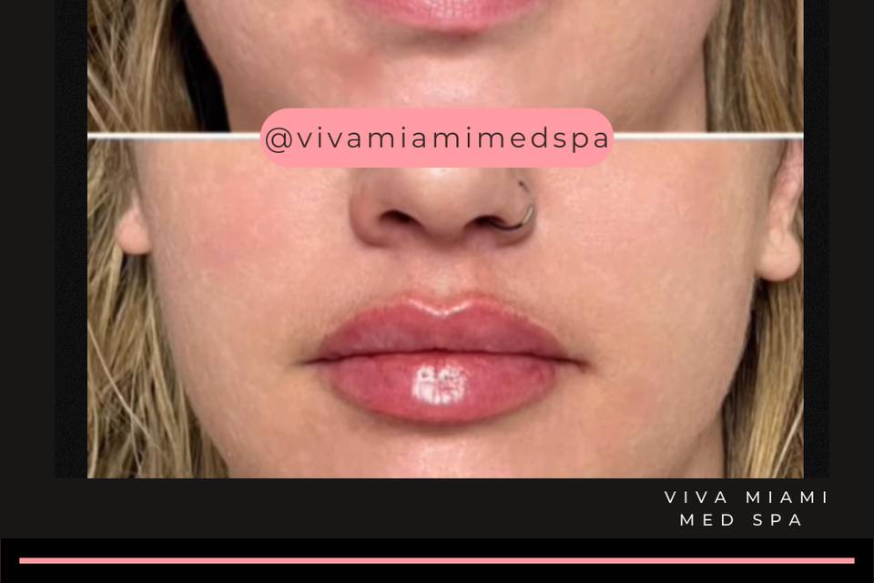 Before and After Lip Filler