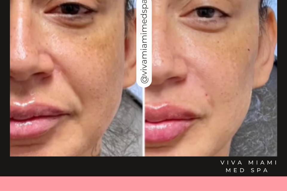 Before and After Lip Filler