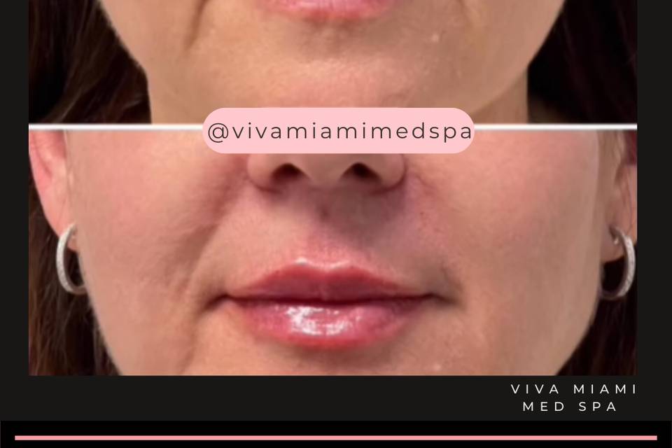 Before and After Lip Filler