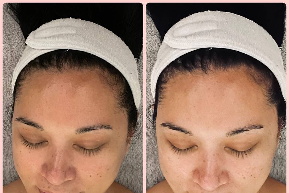 Facial Before & After