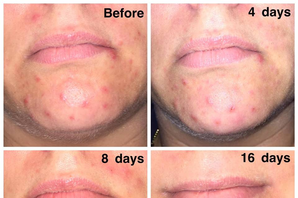 Dealing with acne? I can help you clear it up and get your skin in perfect condition for your special day, and always. Ask me how.