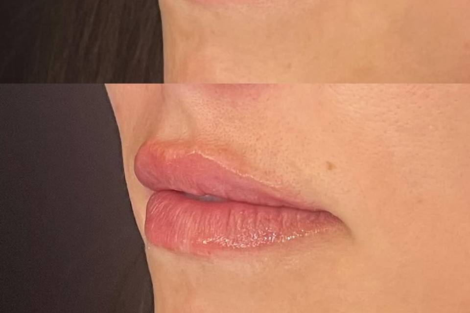 Before & After Lips- Kelsey