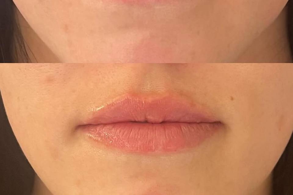 Before & After Lips- Kelsey