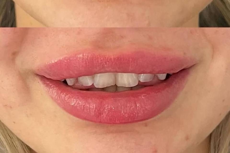 Before & After Lips- Kelsey