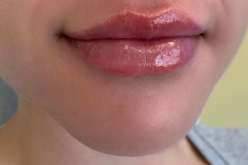 Lip Filler natural enhancement