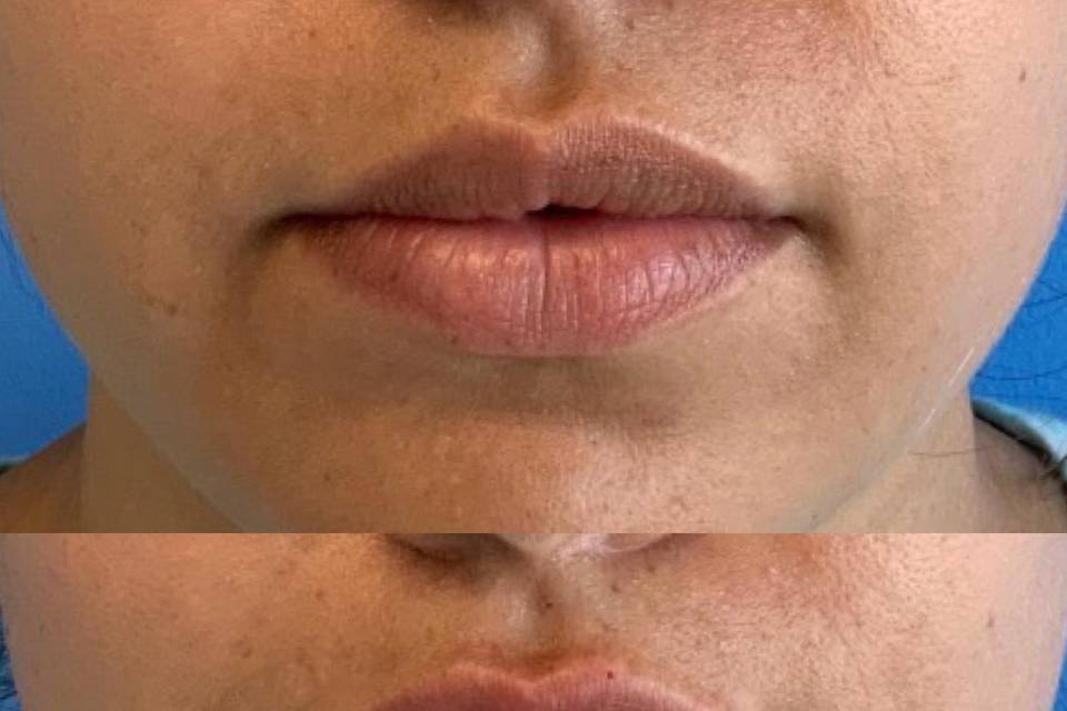 Lip Hydration