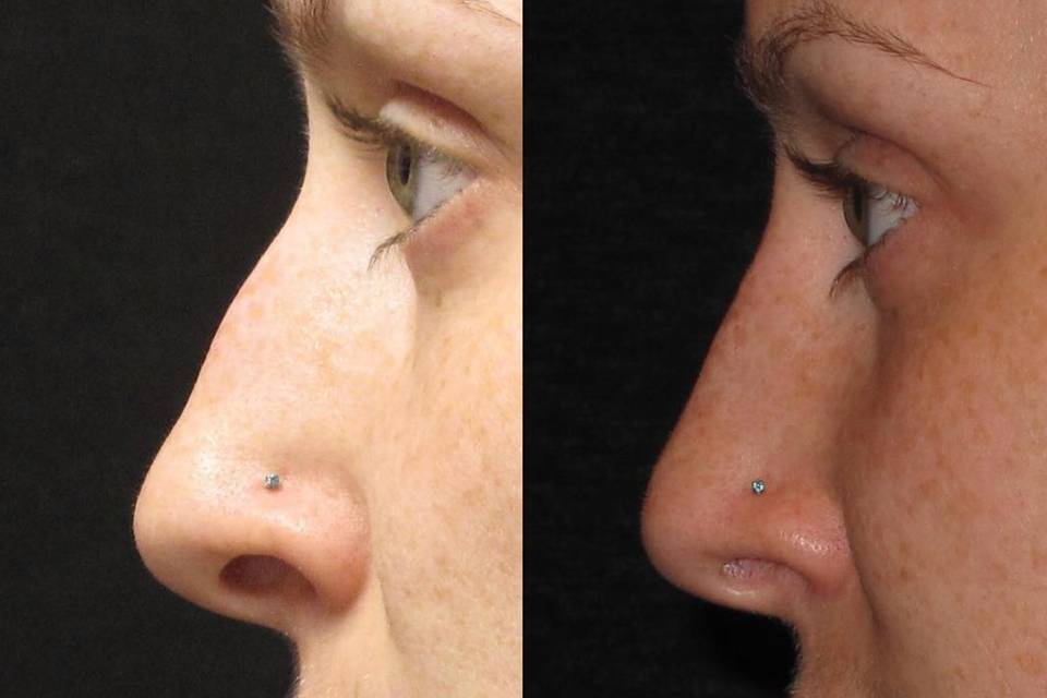 Non-surgical nose job