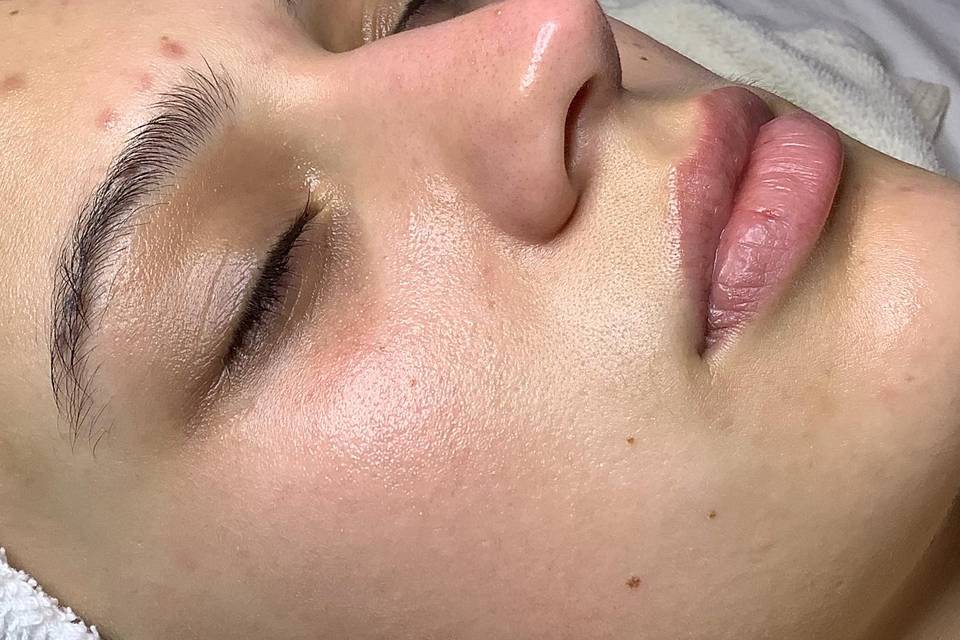 After High Frequency Facial