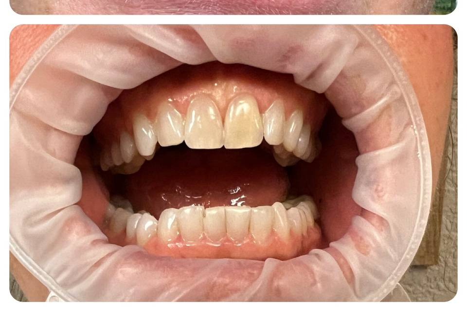 Sunna Smile teeth whitening