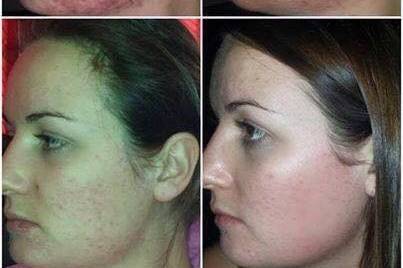 Luminesce Serum Results