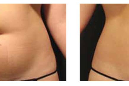 Velashape bodysculpting