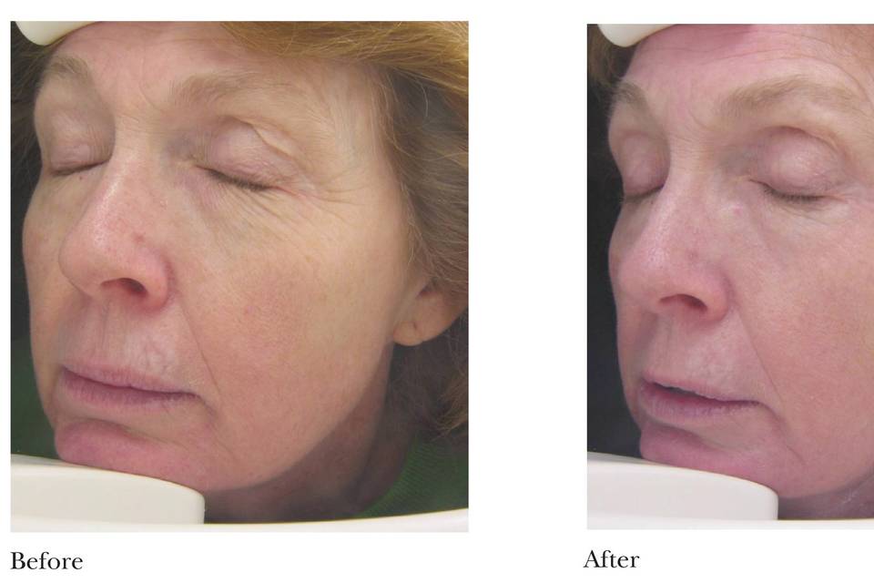 Sublative RF Microneedling