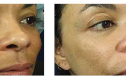 Sublative RF Microneedling