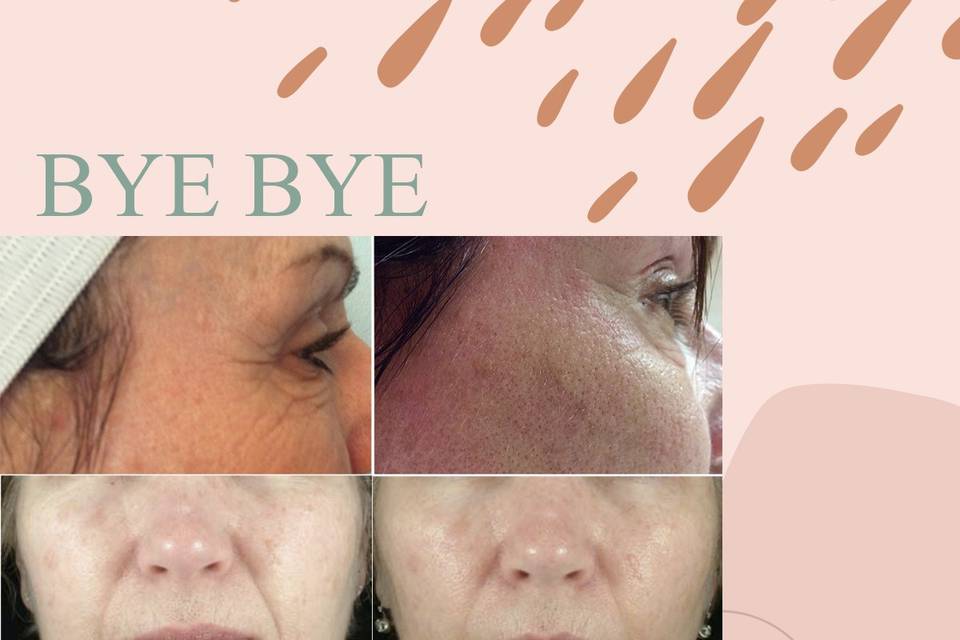 Sublative RF microneedling