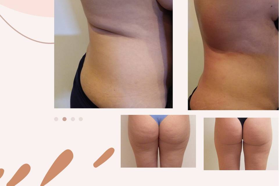 Velashape bodysculpting