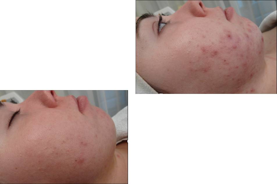 BDR microneedling/acne peel
