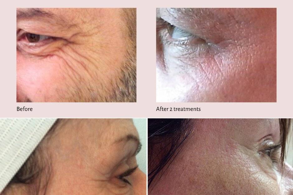 Sublative RF microneedling