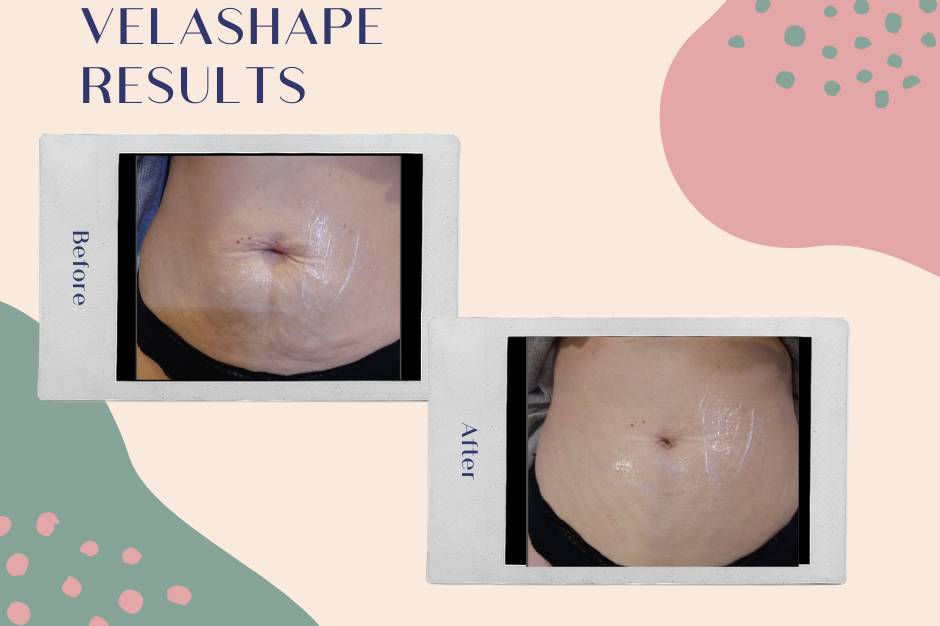 Velashape bodysculpting