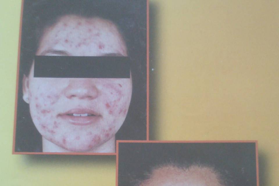 THE FACIAL COMPANY ACNE CLINIC