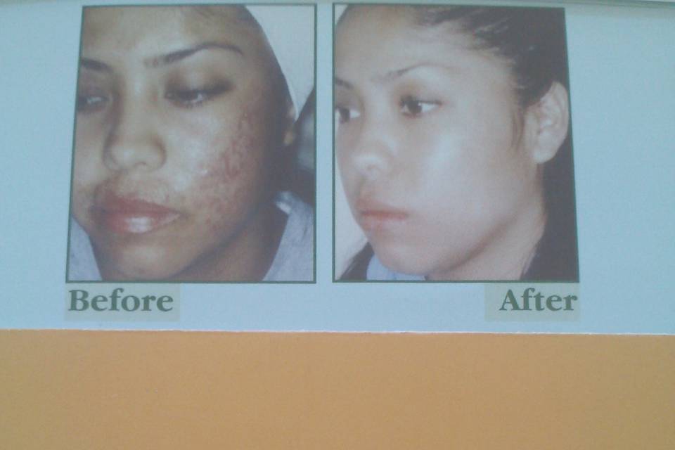 THE FACIAL COMPANY ACNE CLINIC