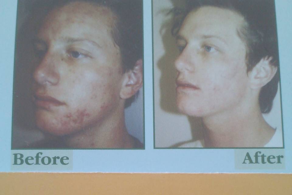 THE FACIAL COMPANY ACNE CLINIC