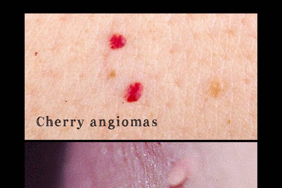 Skin tag and cherry angioma removal