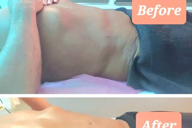 Brazilian Lymphatic Drainage