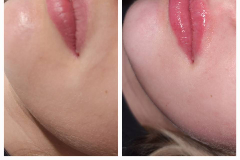 Lip Fill