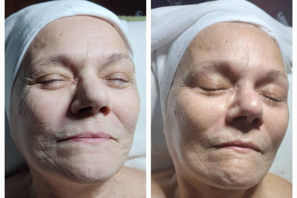 Classic Facial Results Anti- A