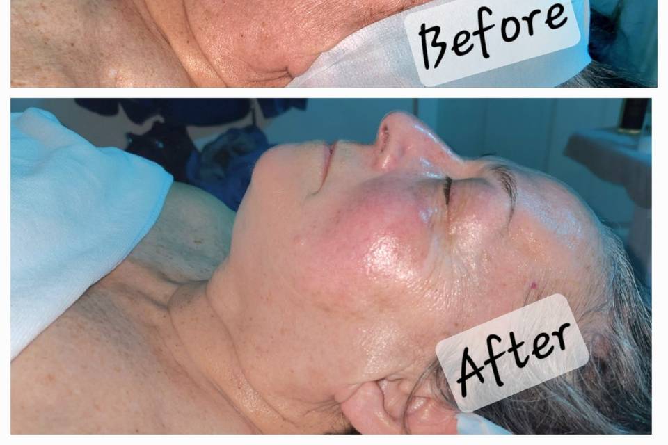 Anti- Aging Facial