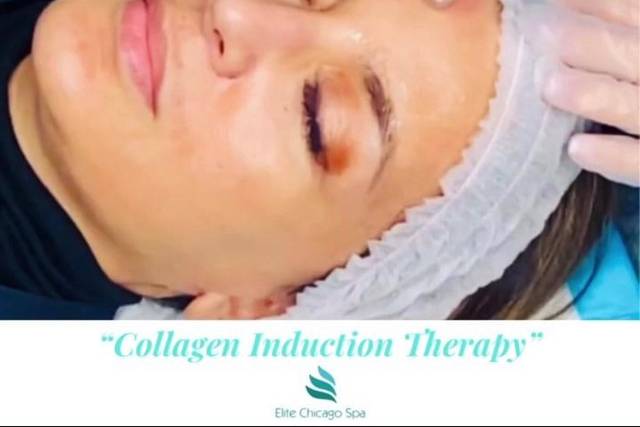 Microneedle