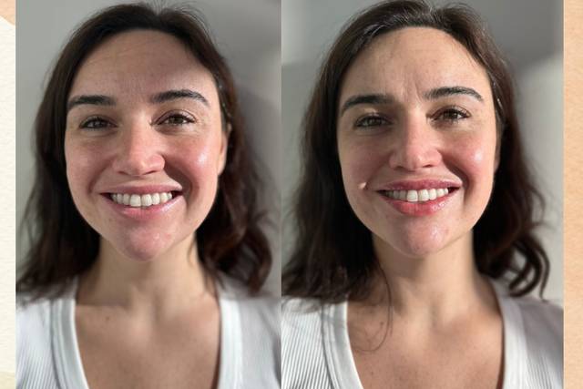 Lip filler