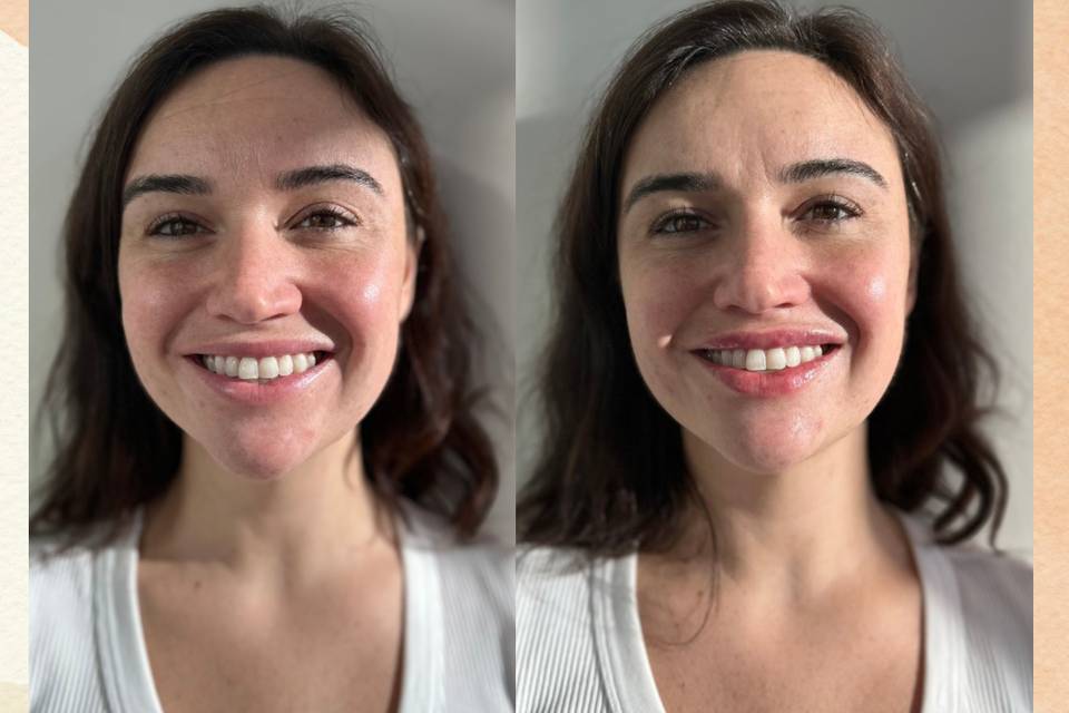 Lip filler