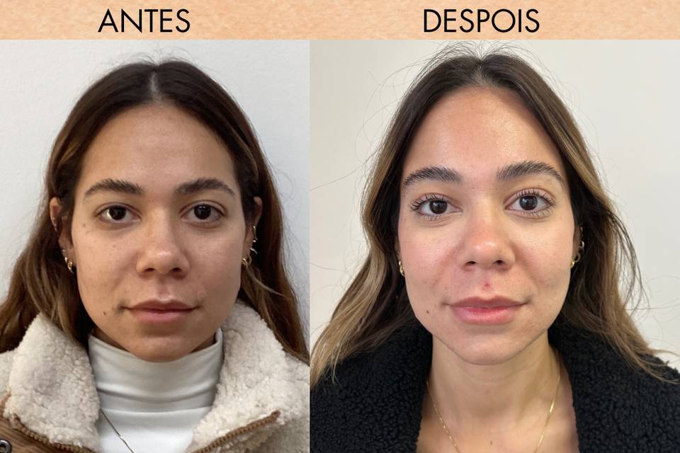 Upper face botox