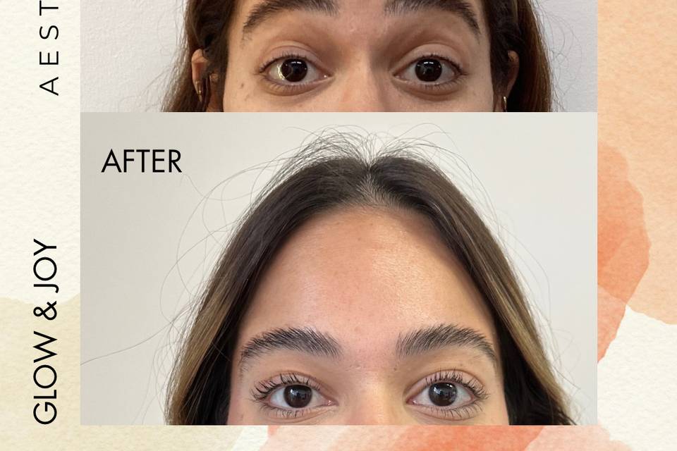 Botox