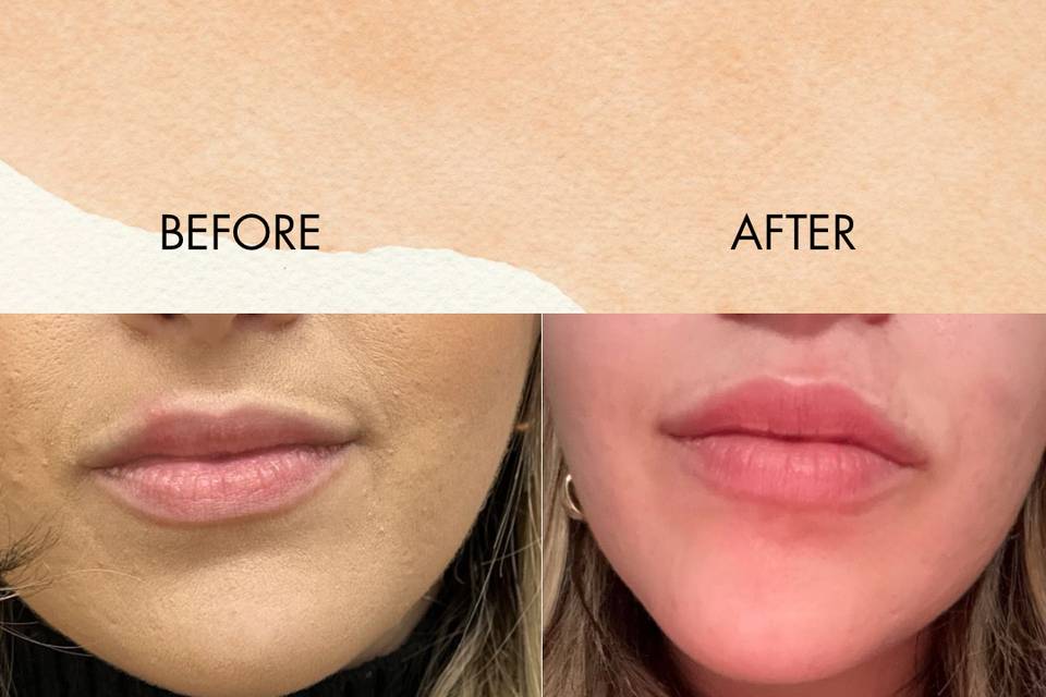 Lip flip