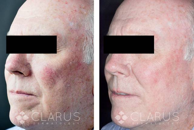 Clarus Dermatology