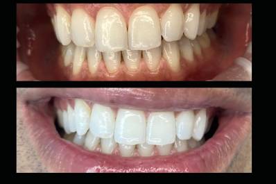 Reno's Best Wedding Whitening