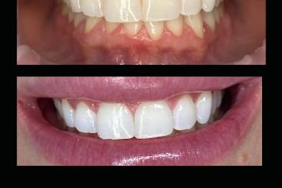 Reno's Best Wedding Whitening