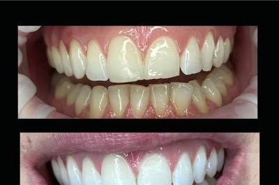 Reno's Best Wedding Whitening