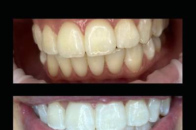 Reno's Best Wedding Whitening
