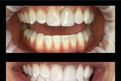 Reno's Best Wedding Whitening