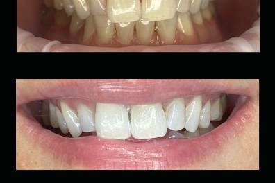 Reno's Best Wedding Whitening