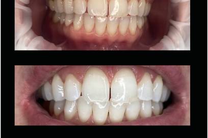 Reno's Best Wedding Whitening